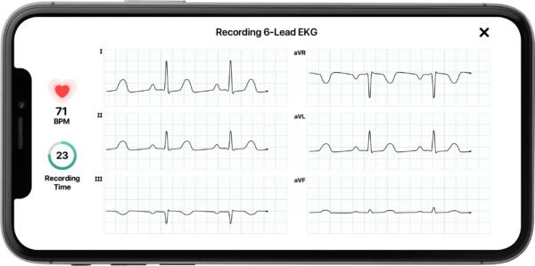 dd14d0a11ebd4117a35732a39270930f KardiaMobile 6L Personal EKG Monitor with Most Smartphones
